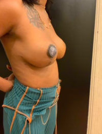 Breast Lift