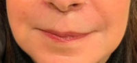 Lip Lift
