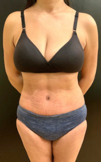 Tummy Tuck (Abdominoplasty)