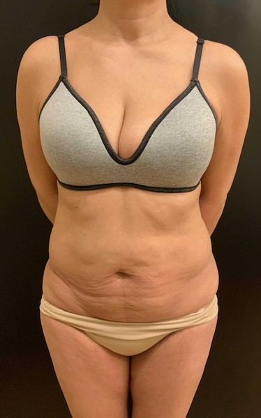 Tummy Tuck (Abdominoplasty)