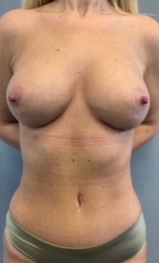 Breast Lift