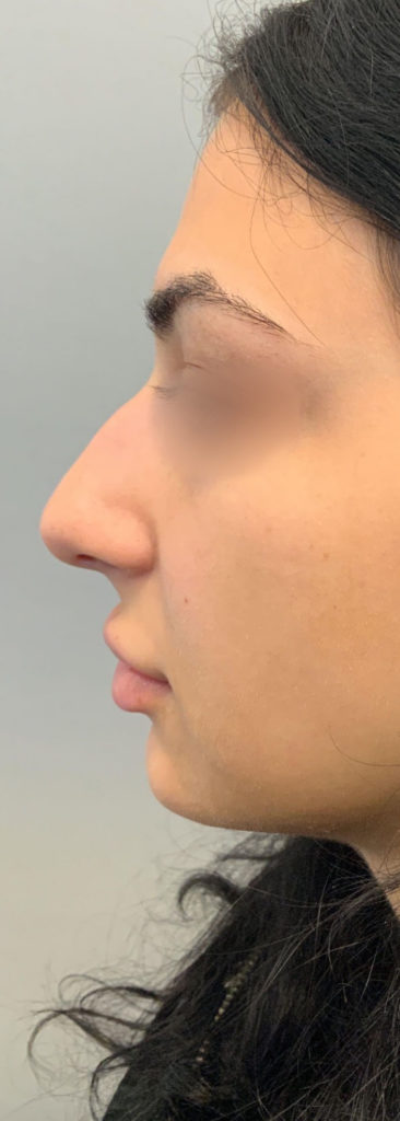 Liquid Rhinoplasty