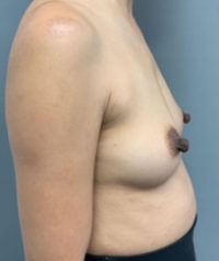 Nipple Reduction