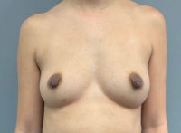 Nipple Reduction