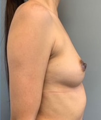 Nipple Reduction