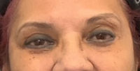 Blepharoplasty