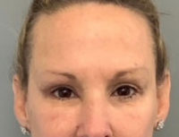 Blepharoplasty