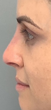 Liquid Rhinoplasty