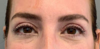 Blepharoplasty