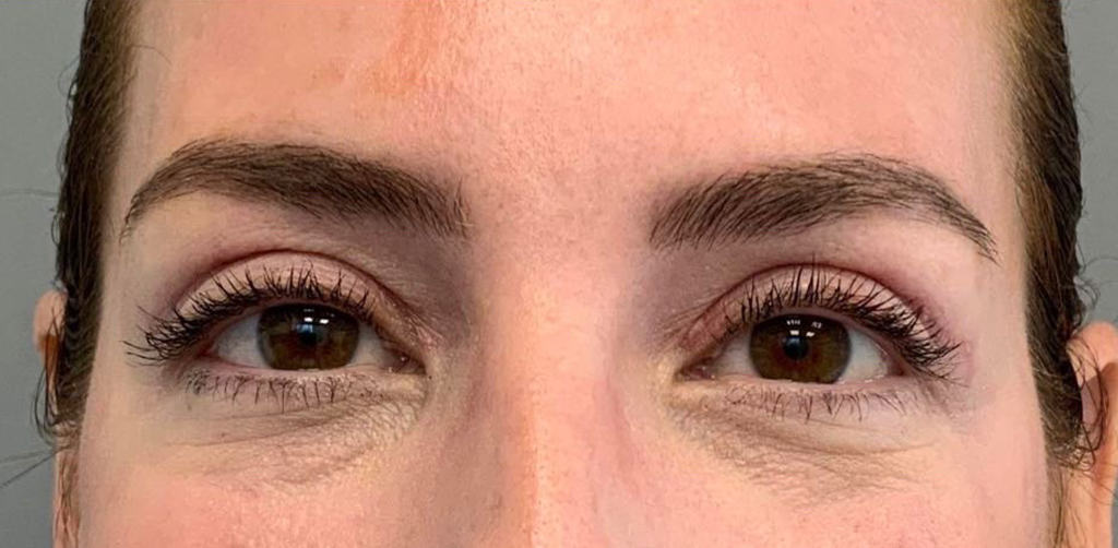 Blepharoplasty
