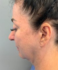 Facelift