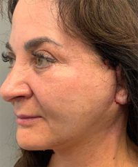 Facelift