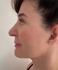 Facelift