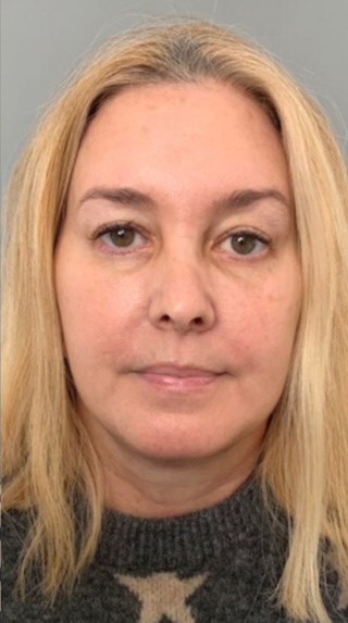 Facelift