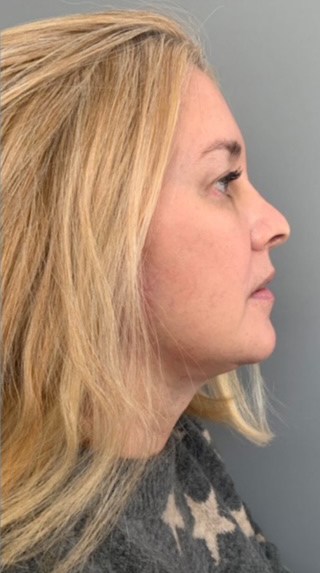 Facelift