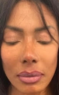 Liquid Rhinoplasty