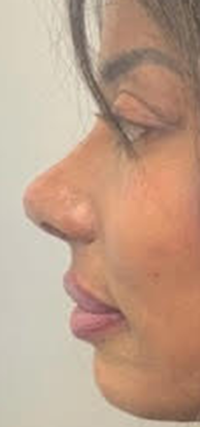 Liquid Rhinoplasty