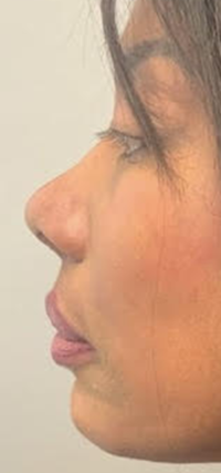 Liquid Rhinoplasty