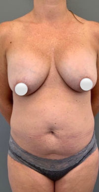 Breast Revision / Capsular Contracture