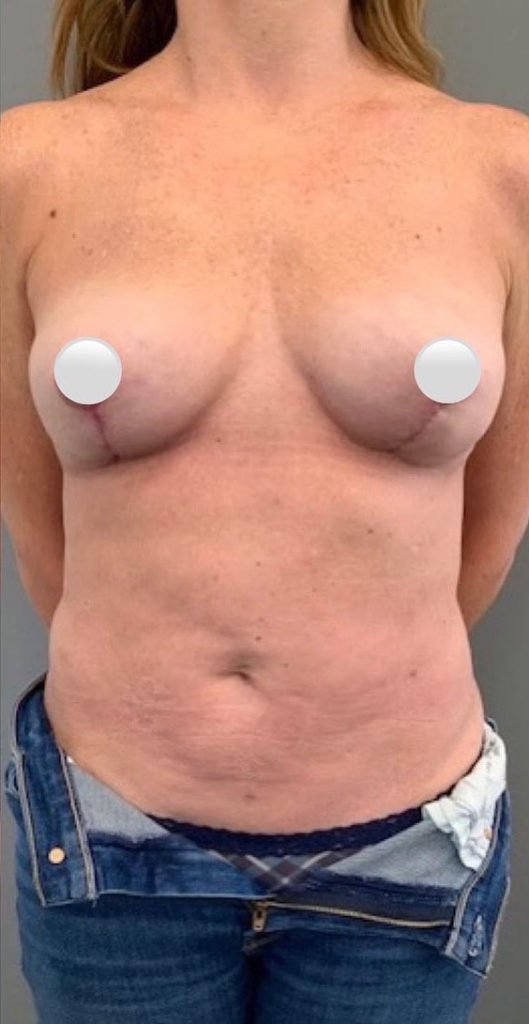 Breast Revision / Capsular Contracture