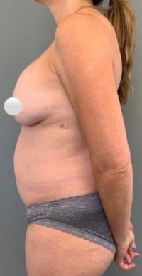 Breast Revision / Capsular Contracture