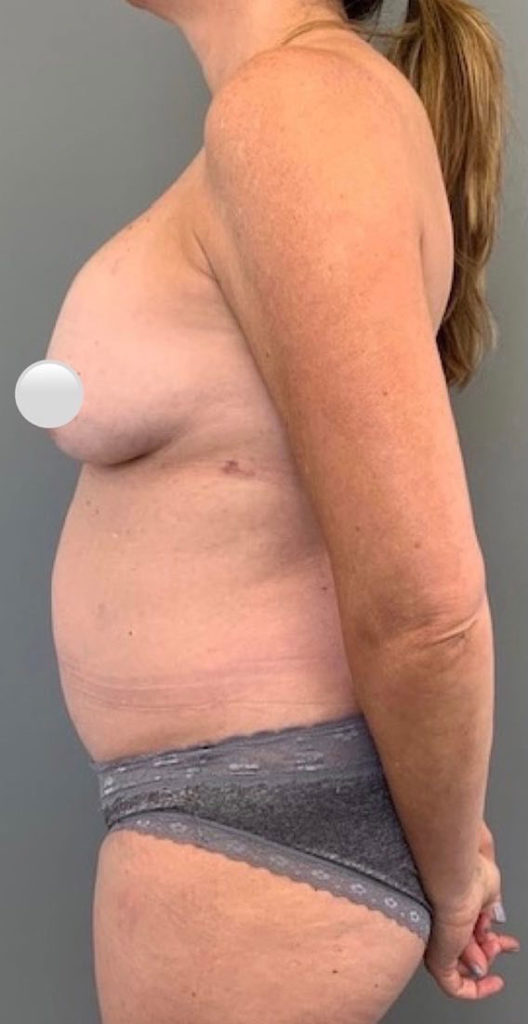 Breast Revision / Capsular Contracture