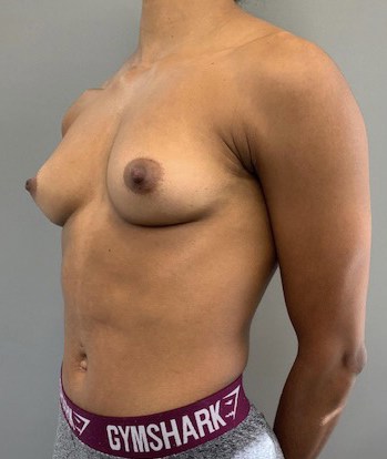 Breast Augmentation