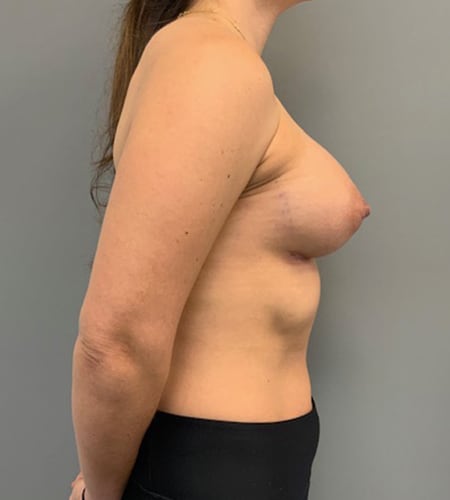 Breast Augmentation
