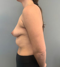 Breast Augmentation