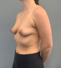 Breast Augmentation