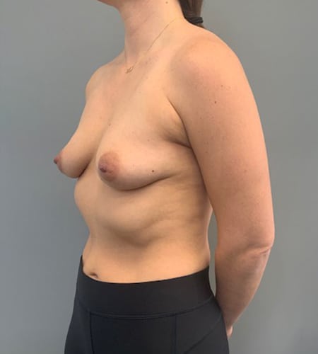 Breast Augmentation