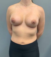 Breast Augmentation