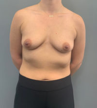 Breast Augmentation