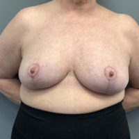 Breast Reduction