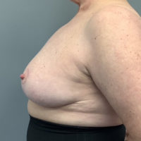 Breast Reduction