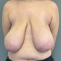 Breast Reduction