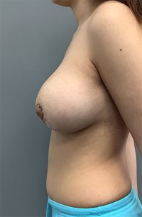 Breast Augmentation