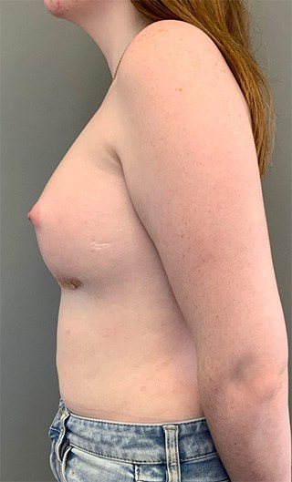 Breast Augmentation with Fat Grafting