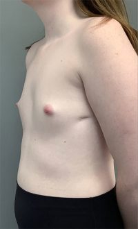 Breast Augmentation with Fat Grafting