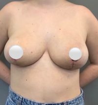 Breast Reduction