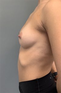 Breast Augmentation