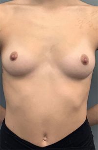 Breast Augmentation
