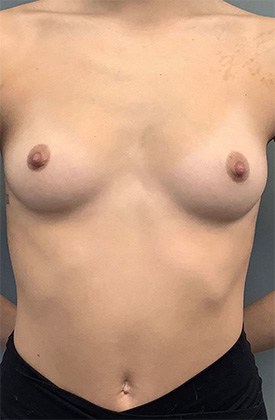 Breast Augmentation
