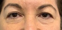 Blepharoplasty