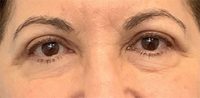 Blepharoplasty