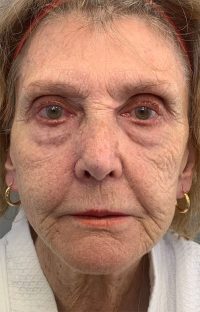 Laser Resurfacing
