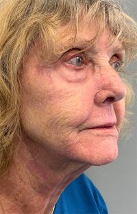 Laser Resurfacing