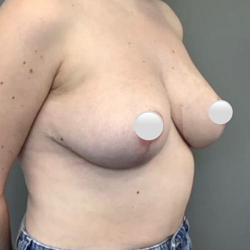 Breast Reduction