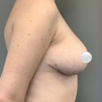 Breast Reduction