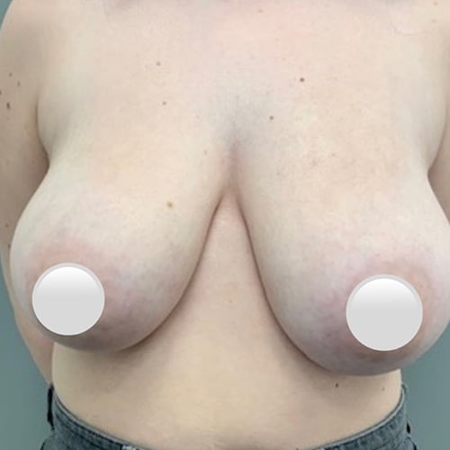 Breast Reduction